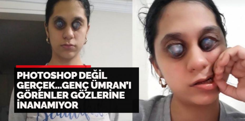 Doğuştan göz tansiyonuna bağlı